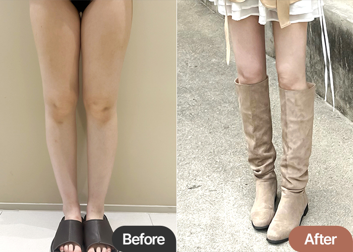 thigh-liposuction-thumbnail-mj
