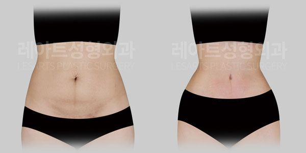 tummy tuck before and after - lesarts plastic surgery