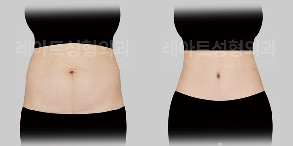 tummy tuck before and after - lesarts plastic surgery