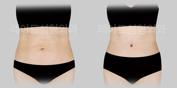 tummy tuck before and after - lesarts plastic surgery