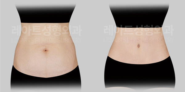 tummy tuck before and after - lesarts plastic surgery