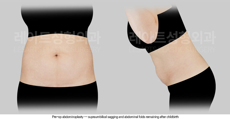 tummy-tuck-02-01-260602