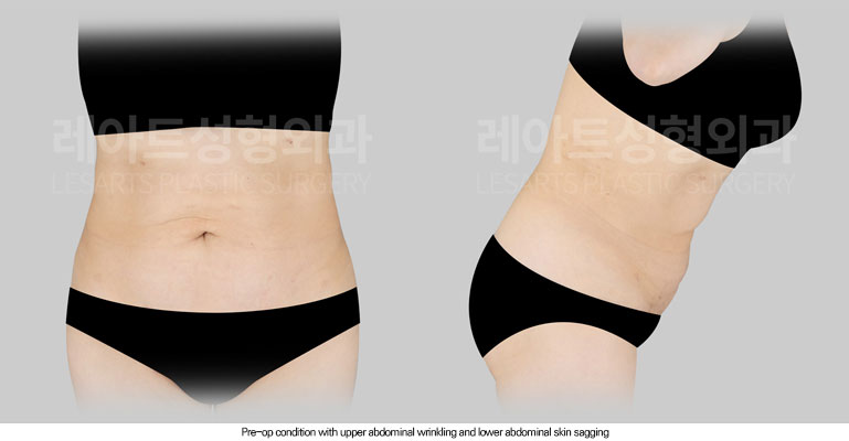 tummy-tuck-02-01-260605