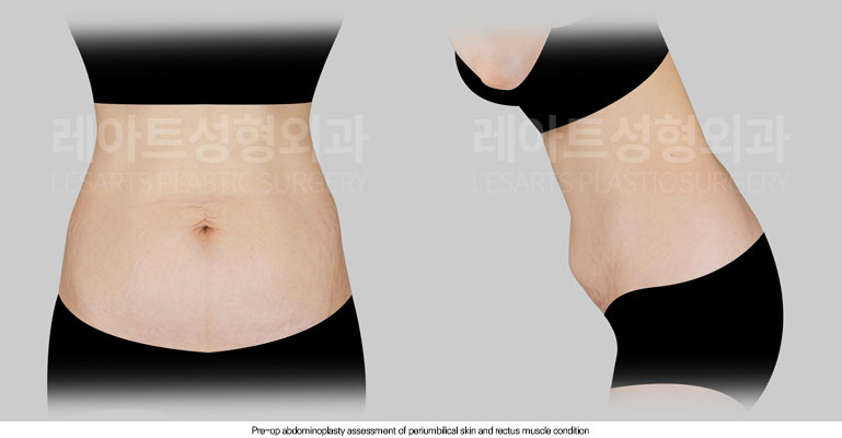 tummy-tuck-02-01-260612