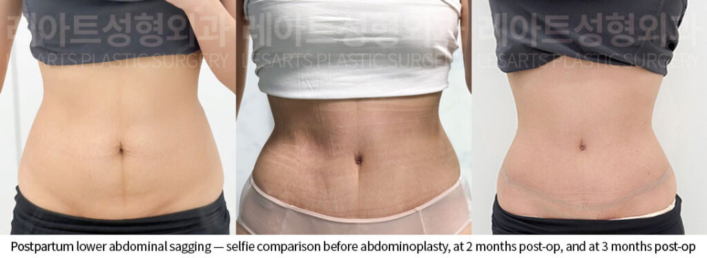 tummy-tuck-02-02-260528