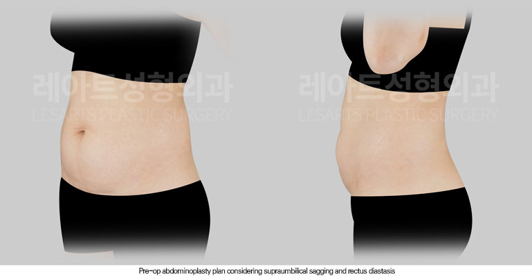 tummy-tuck-02-02-260602