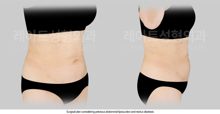 tummy-tuck-02-02-260605