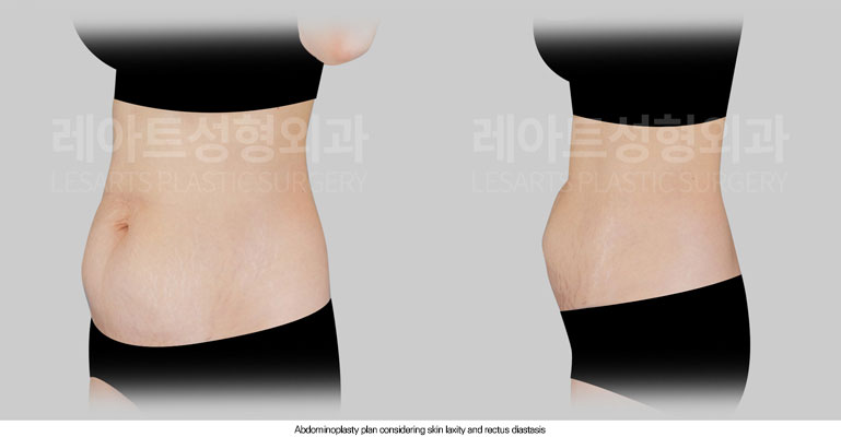 tummy-tuck-02-02-260612
