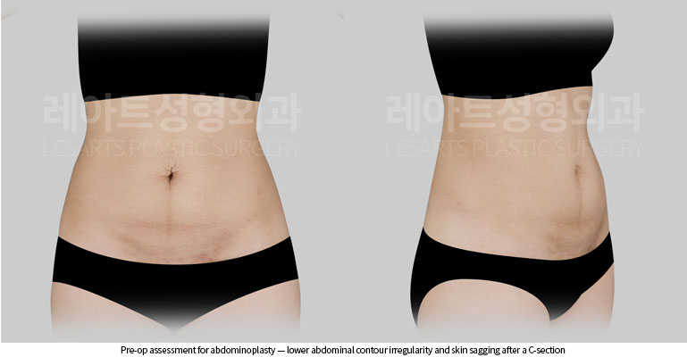tummy-tuck-02-03-260528
