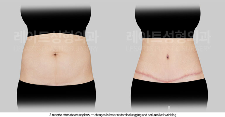 tummy-tuck-02-03-260602