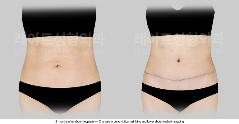 tummy-tuck-02-03-260605