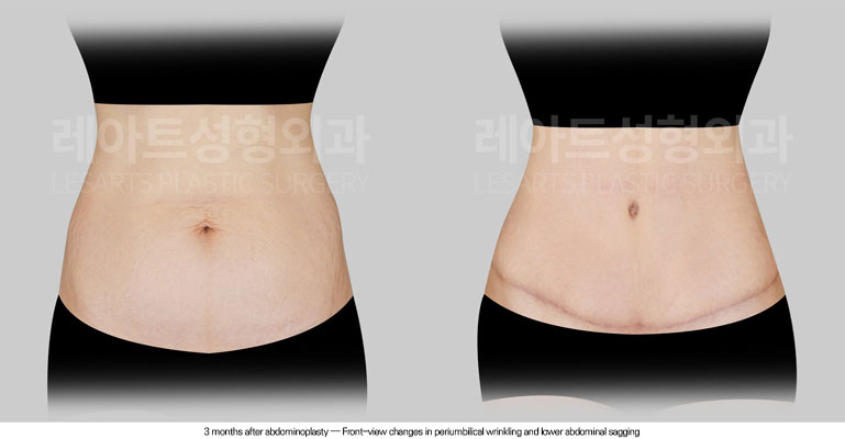 tummy-tuck-02-03-260612