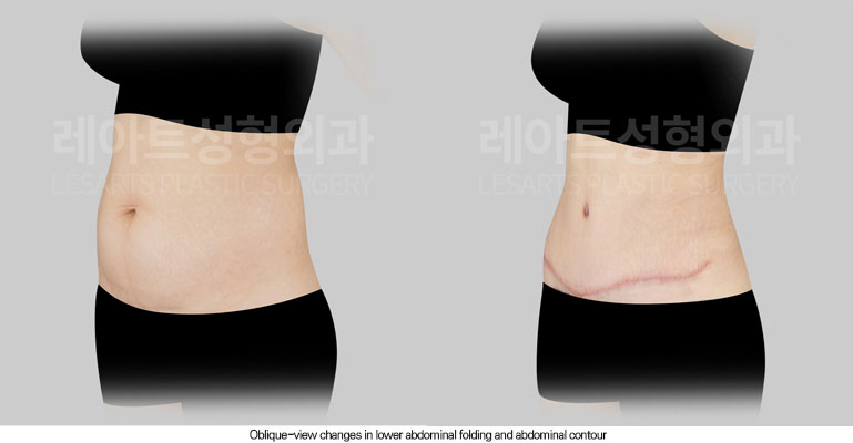 tummy-tuck-02-04-260602