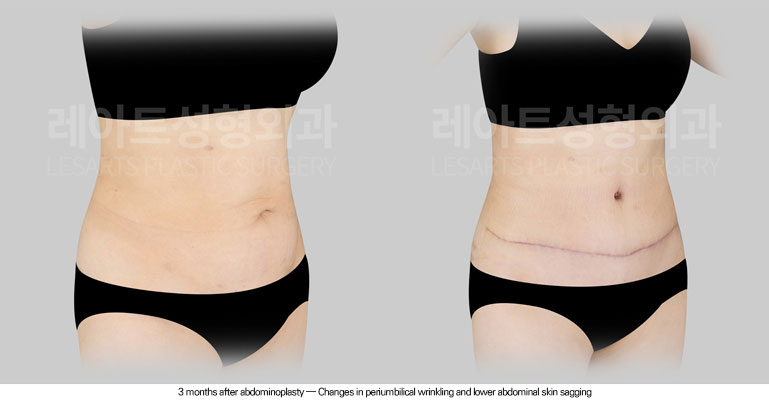 tummy-tuck-02-04-260605