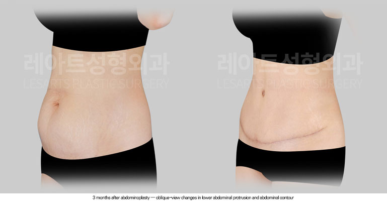 tummy-tuck-02-04-260612