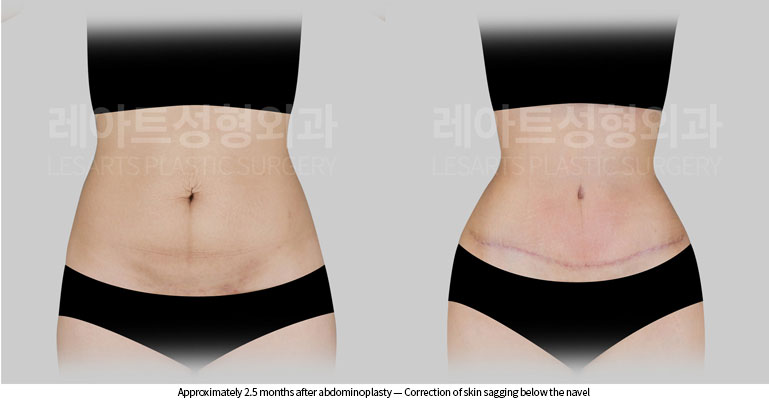 tummy-tuck-02-05-260528