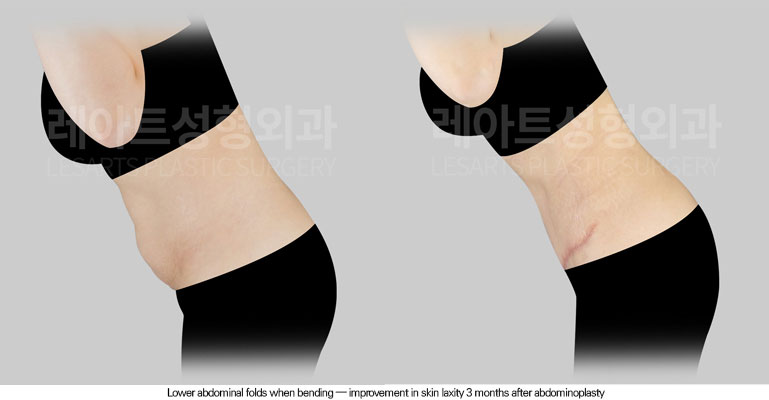 tummy-tuck-02-05-260602