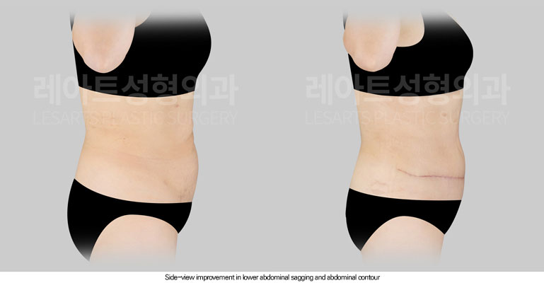 tummy-tuck-02-05-260605
