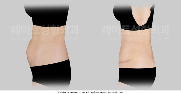 tummy-tuck-02-05-260612