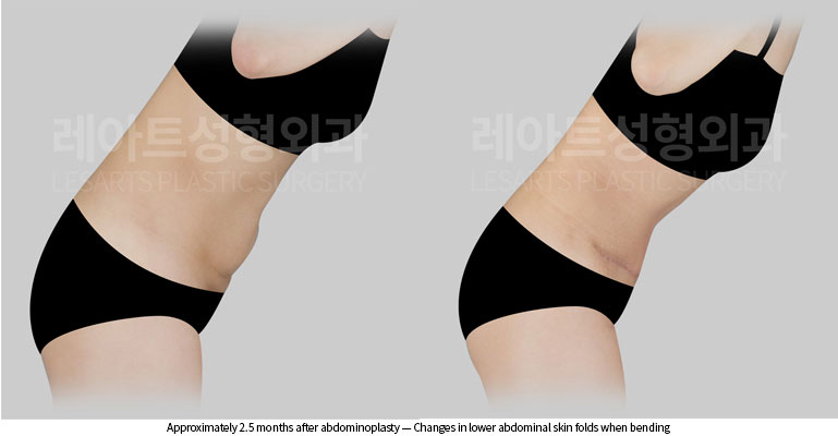 tummy-tuck-02-06-260528