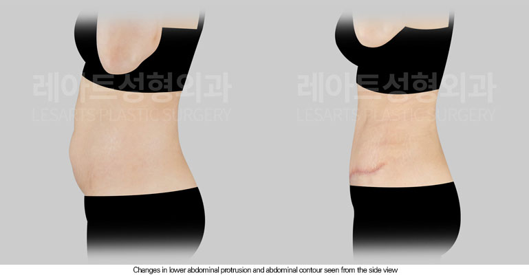 tummy-tuck-02-06-260602