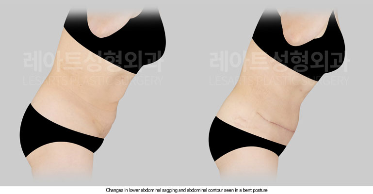 tummy-tuck-02-06-260605