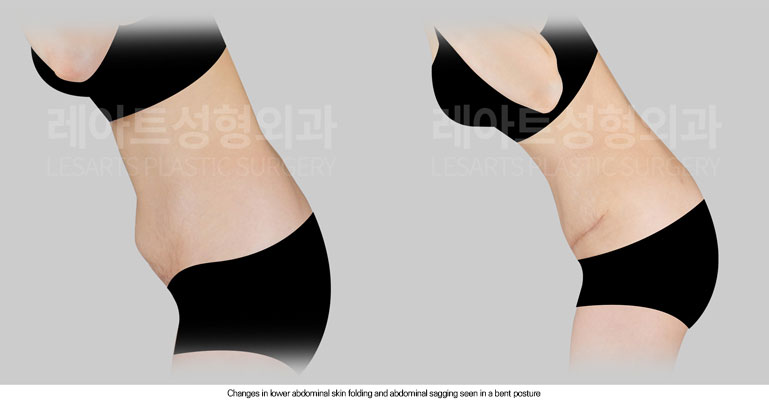 tummy-tuck-02-06-260612