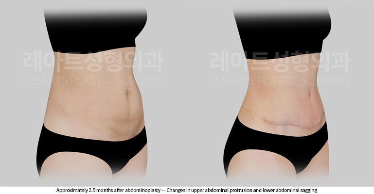 tummy-tuck-02-07-260528