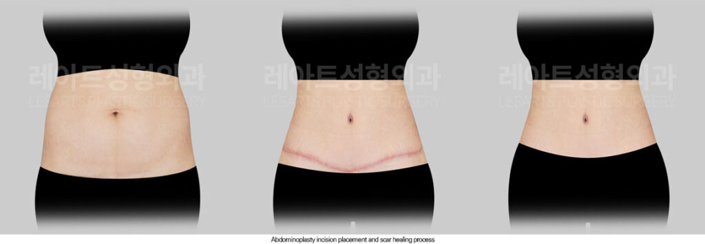tummy-tuck-02-07-260602
