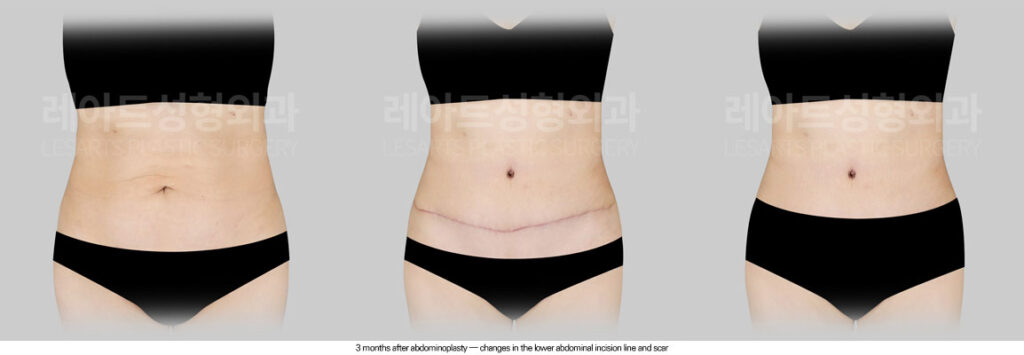 tummy-tuck-02-07-260605