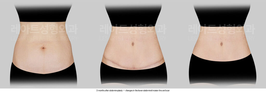 tummy-tuck-02-07-260612