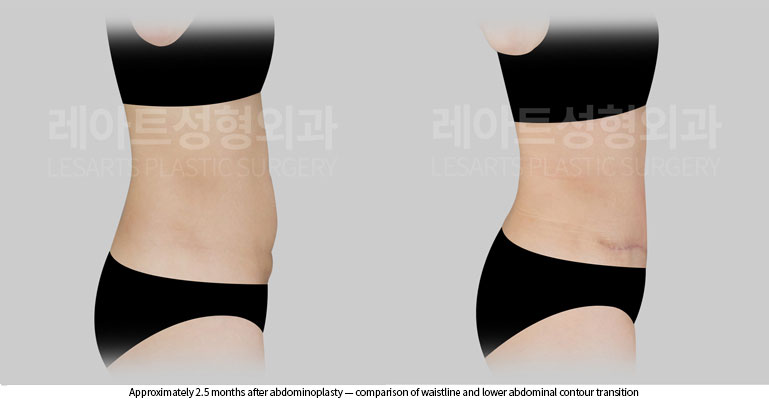 tummy-tuck-02-08-260528