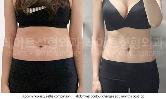 tummy-tuck-02-08-260602