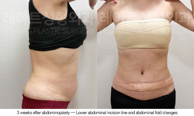tummy-tuck-02-08-260605