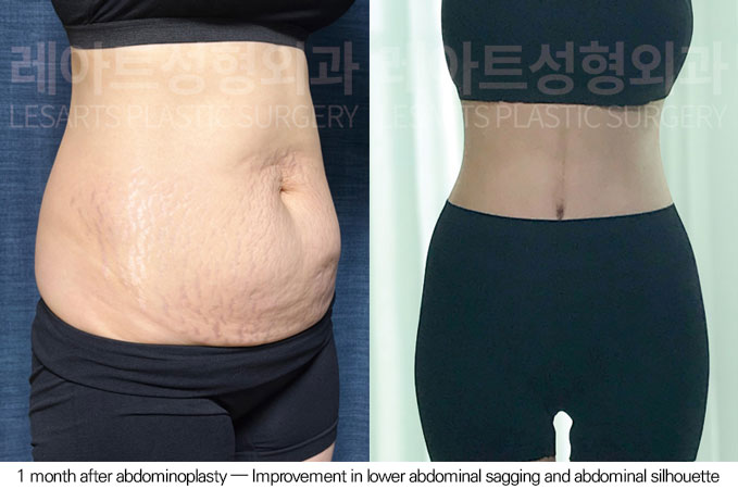 tummy-tuck-02-08-260612