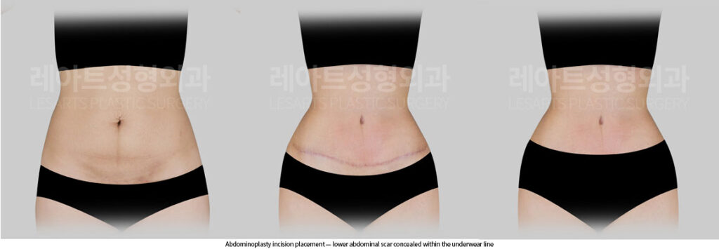 tummy-tuck-02-09-260528