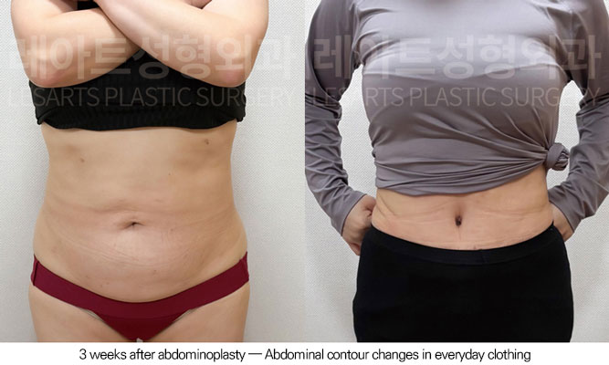tummy-tuck-02-09-260605