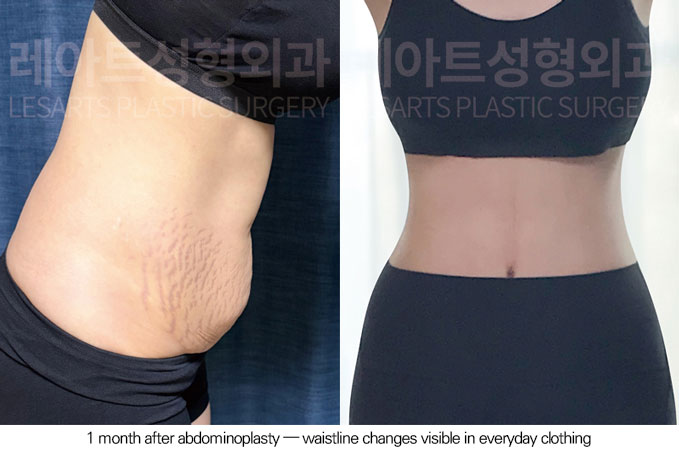 tummy-tuck-02-09-260612