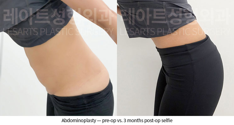 tummy-tuck-02-10-260528