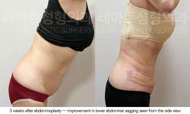 tummy-tuck-02-10-260605