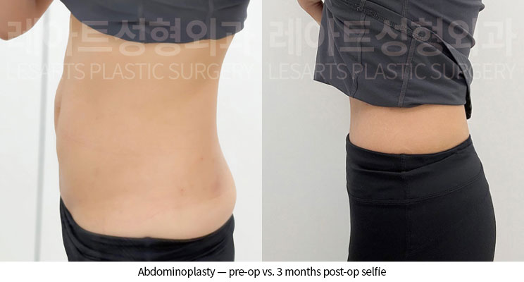 tummy-tuck-02-11-260528