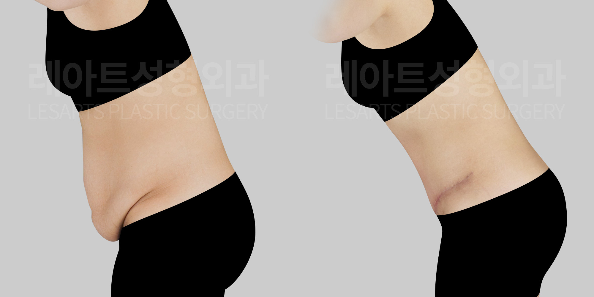 [Abdominoplasty]3 Months After L-Type Extended Abdominoplasty