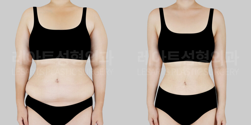 lesarts upper body liposuction brfore and after