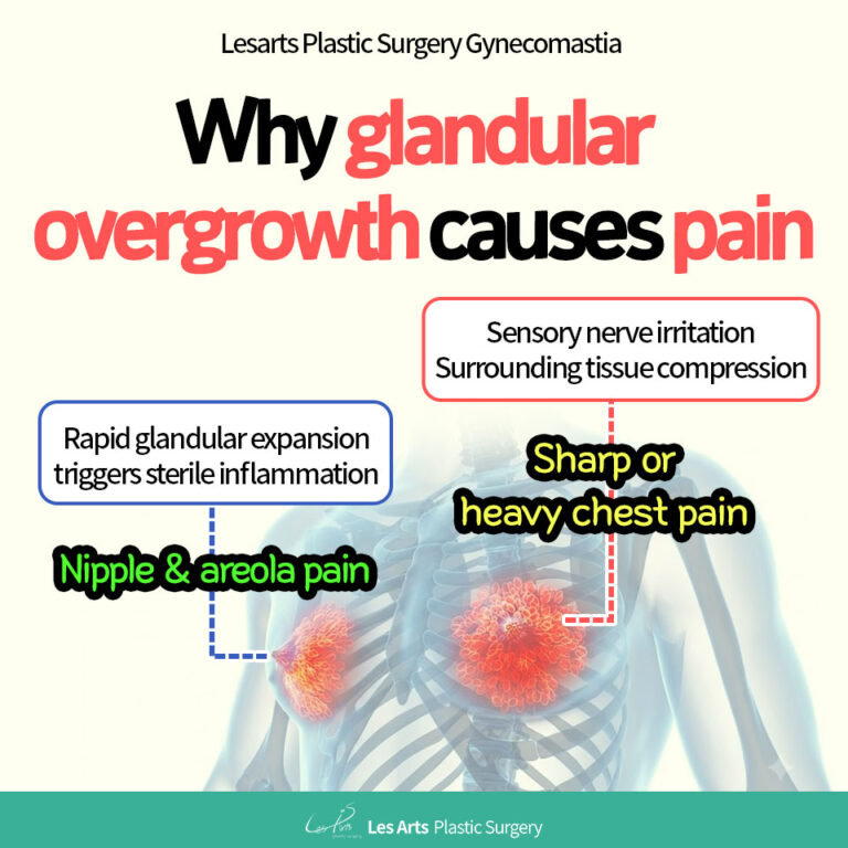 Glandular overgrowth causing chest pain-lesarts
