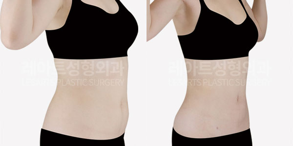 Abdominal liposuction before and after - Lesarts Plastic Surgery