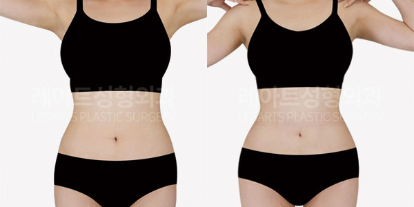 Abdominal liposuction before and after - Lesarts Plastic Surgery