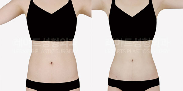 Abdominal liposuction before and after - Lesarts Plastic Surgery