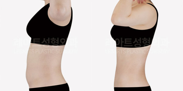 Abdominal liposuction before and after - Lesarts Plastic Surgery