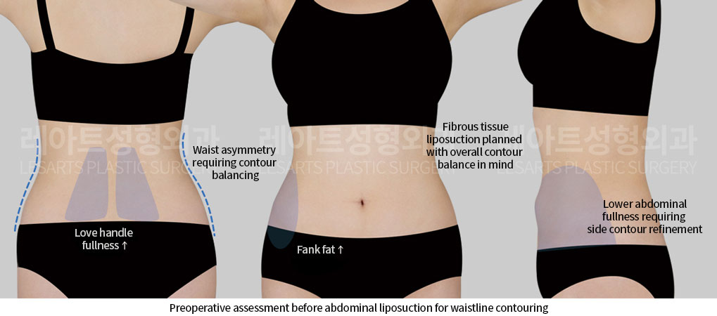 abdominal-liposuction-02-01-260703