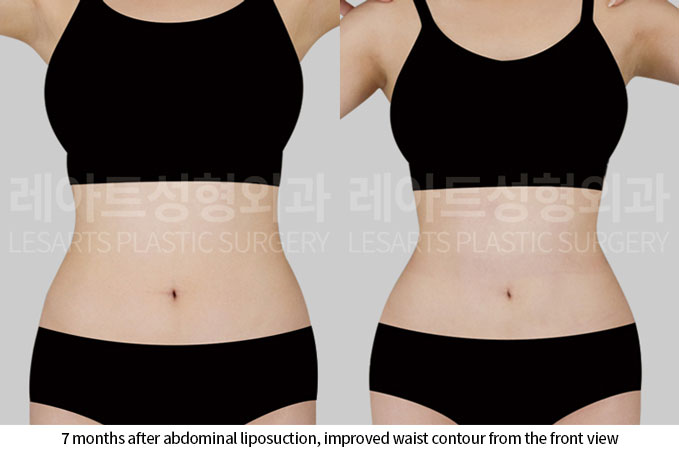 abdominal-liposuction-02-02-260703